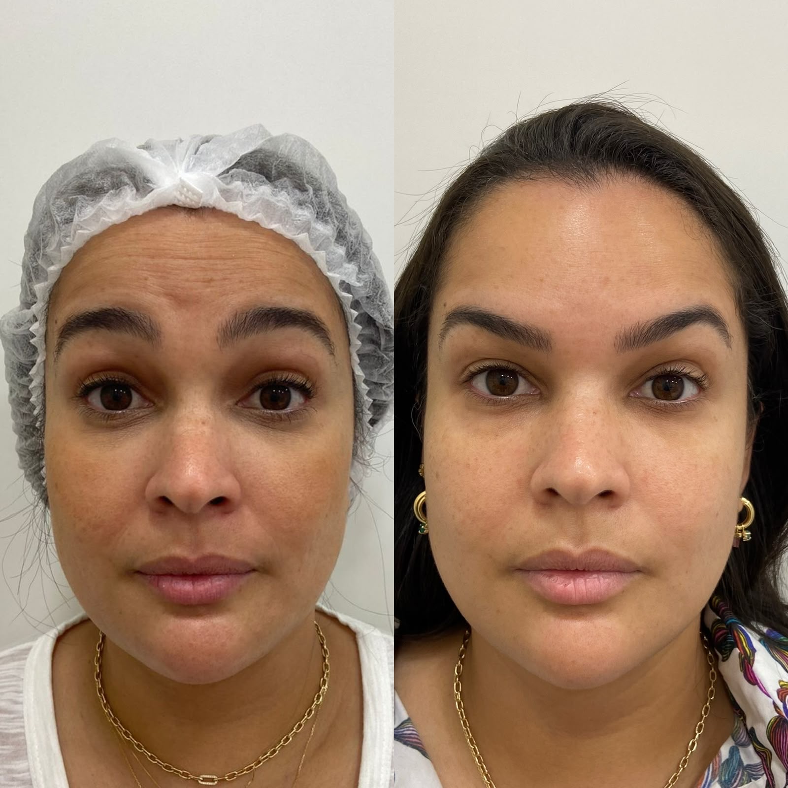 Antes e depois de harmonização facial com suavização de rugas e olhar mais descansado