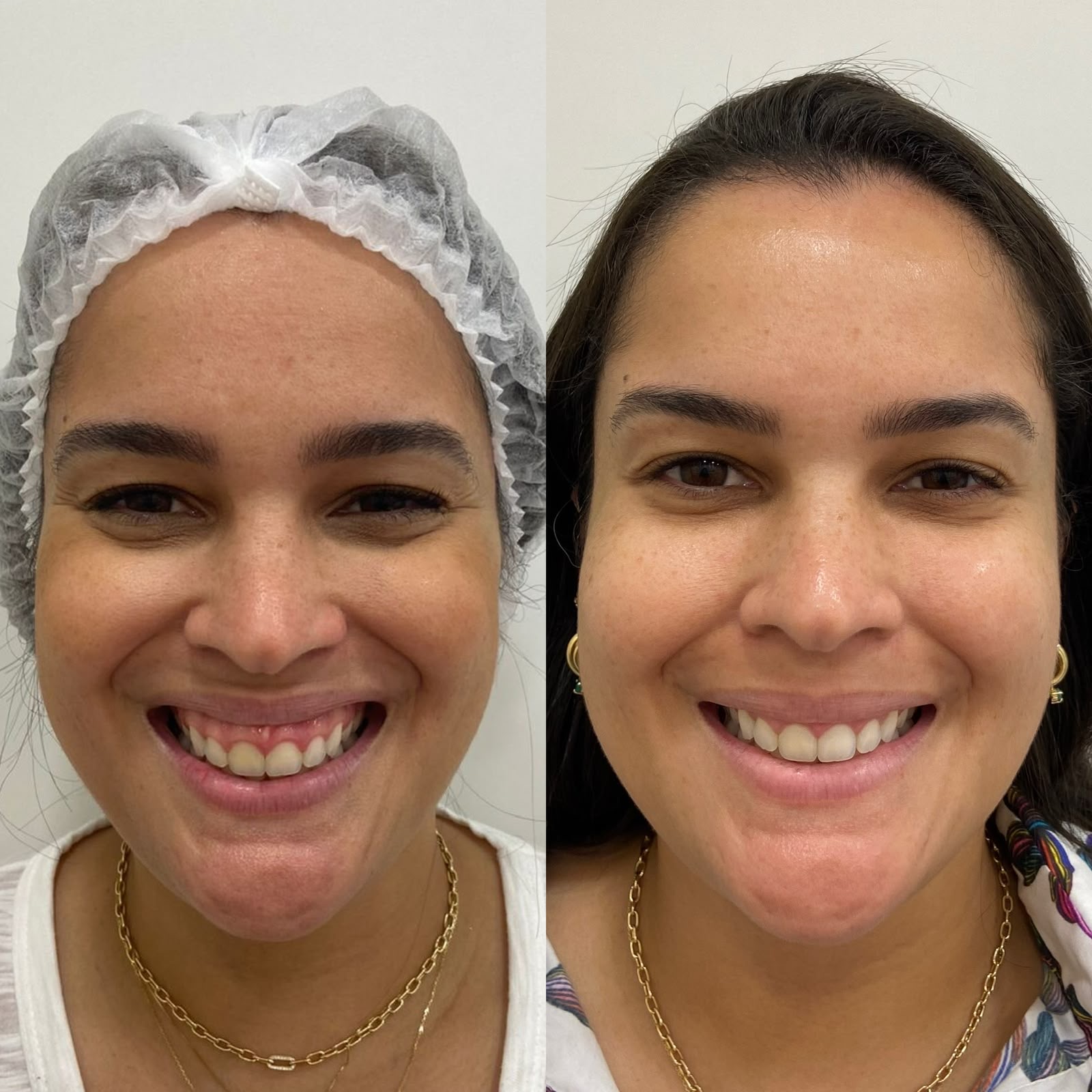 Resultado de harmonização facial: comparação antes e depois do atendimento