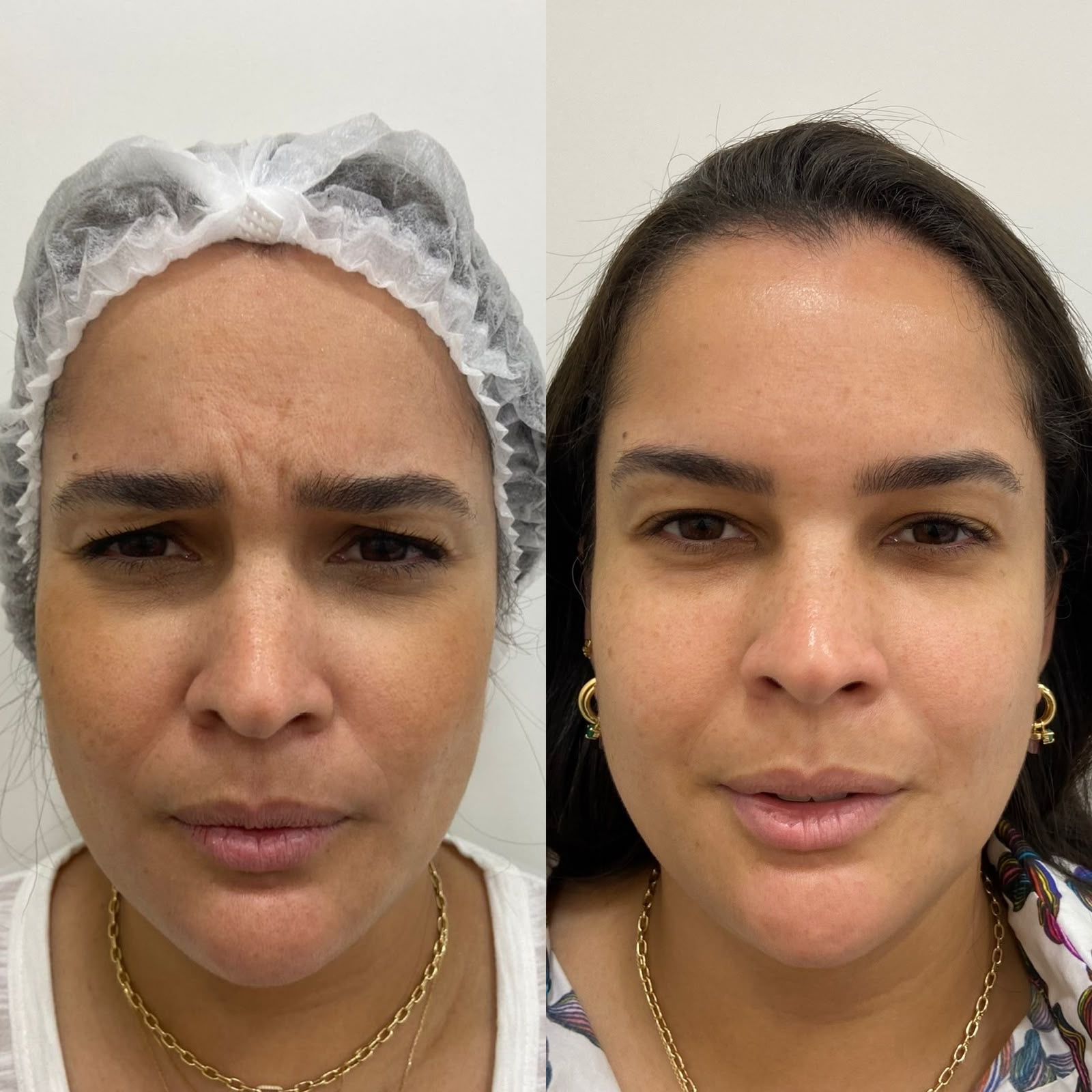 Antes e depois de toxina botulínica na testa e na região dos olhos